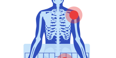 Illustration of Bair Hugger Warming Blanket