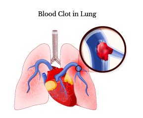 Blood Clot in Lung
