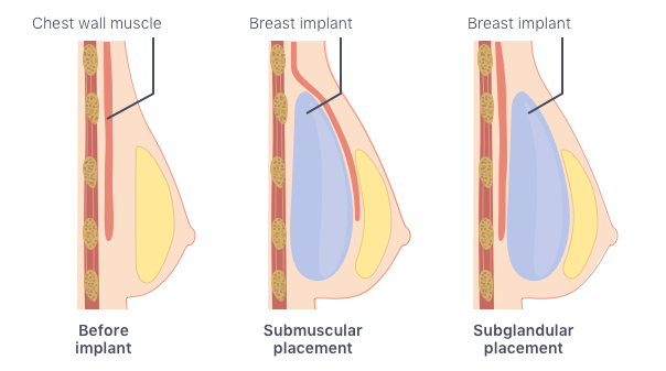 figure showing submuscular and subglandular breast implant placement
