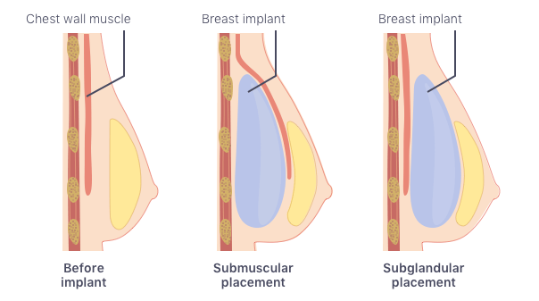 Allergan Breast Implants  Textured vs Smooth, Surgery & Risks