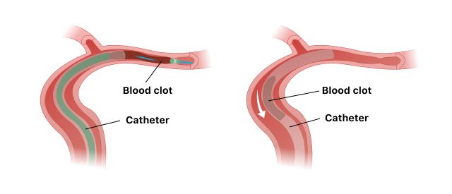 How Penumbra Jet 7 Xtra Flex Catheter removes blood clots