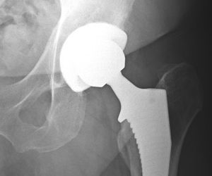 Cementless Total Hip Replacement