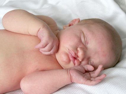 Newborn with Cleft Lip