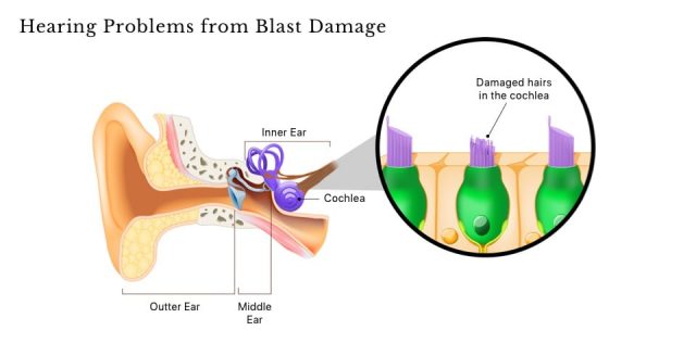 Diagram of damaged cochlea