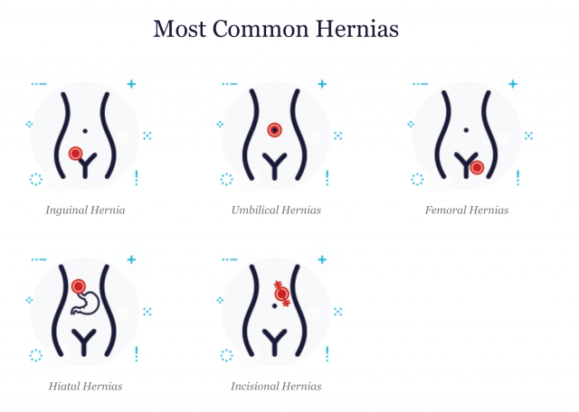 Femoral Hernia: Causes, Symptoms, Treatment