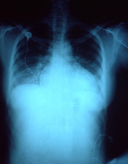 X-ray of woman with congestive heart failure