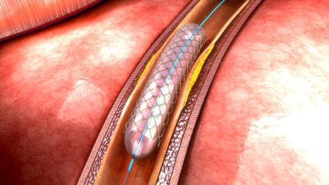 Intravascular Coronary Stent in Vessel