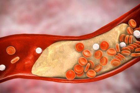 Plaque build-up in arteries