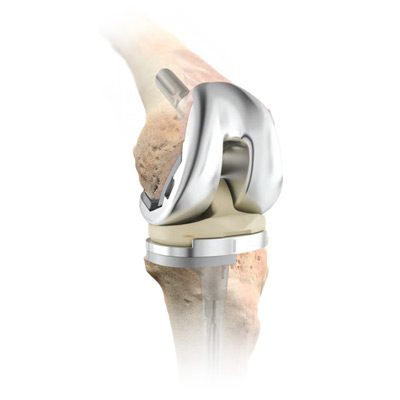 DePuy Attune Knee