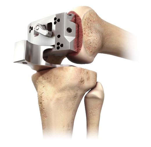 DePuy Sigma Knee System