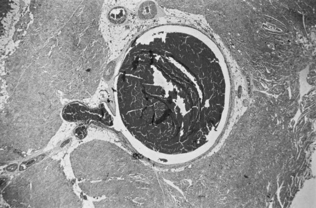 Microscopic view of deep vein thrombosis