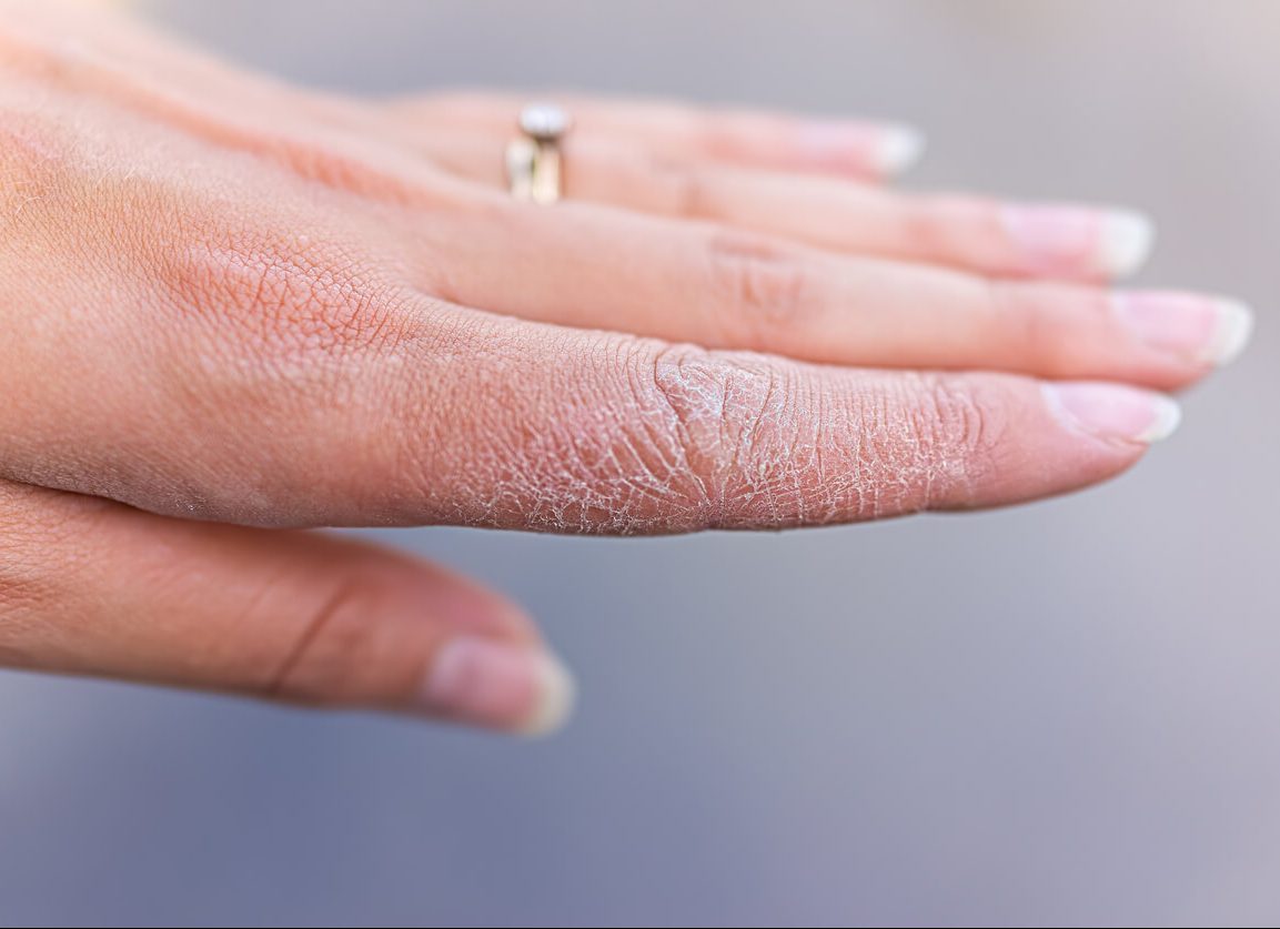Dyshidrotic Eczema Causes Treatments And Prevention 46 OFF