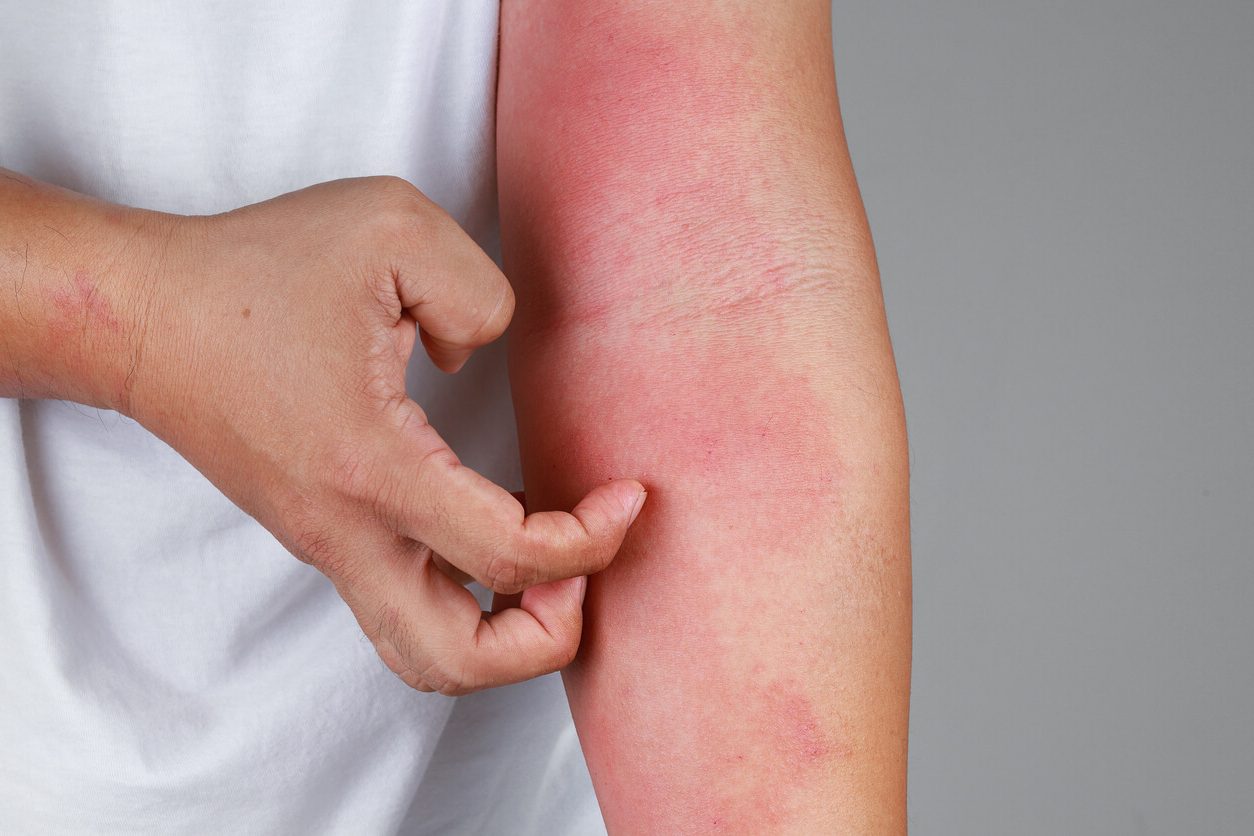 Treating Eczema ( Atopic Dermatitis) and Preventing FlareUps