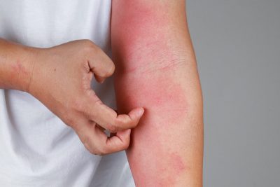 Skin Rashes & Conditions