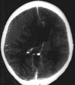 epidural hematoma x-ray