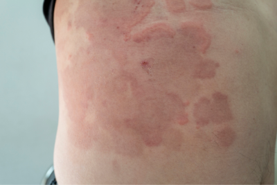 Angry rash under boob, should I worry?