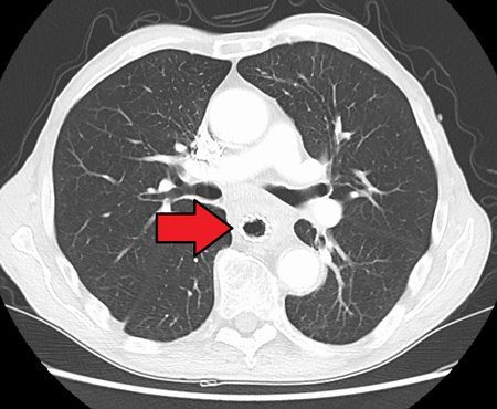 Esophageal Cancer Scan Image