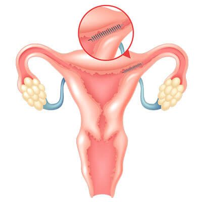 Essure Birth Control Diagram