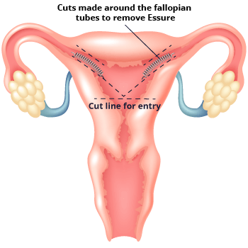 Diagram Of Essure Removal