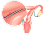 Essure diagram in uterus