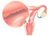 Essure placement