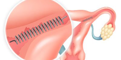 Essure placement