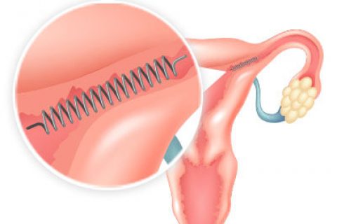 Essure placement