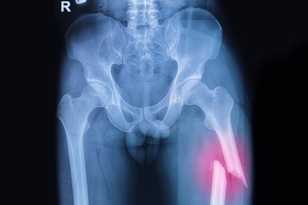 Bone Fracture Highlighted on X-Ray