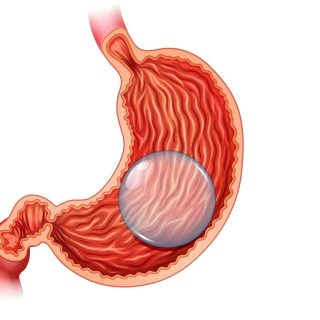 Weight loss gastric balloon