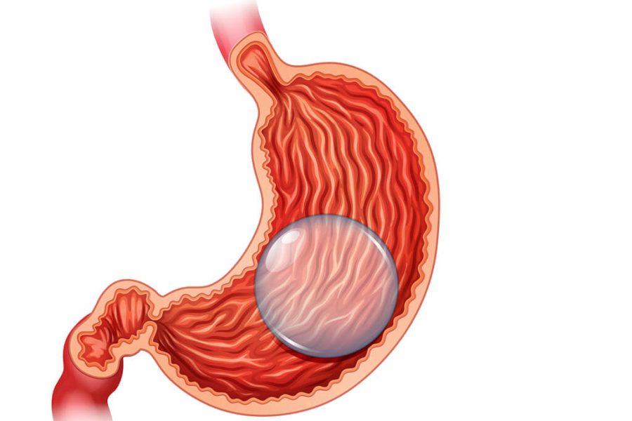 Weight loss gastric balloon