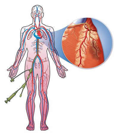 Heart catheter diagram