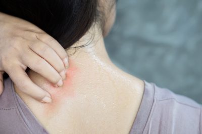 heat rash on neck