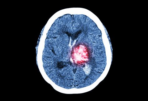 Scan of brain hemorrhage