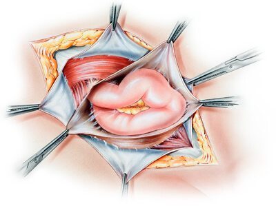 Hernia Mesh Surgery Illustration