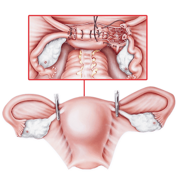 Intercourse After Laparoscopic Surgery 40