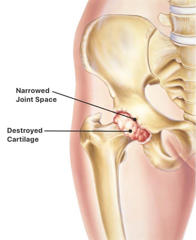 Hip Replacement  Procedure, Symptoms, Types of Implants and Risks