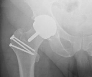 x-ray of resurfaced hip