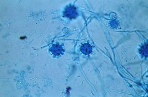 Photomicrograph of a histoplasmosis infection.