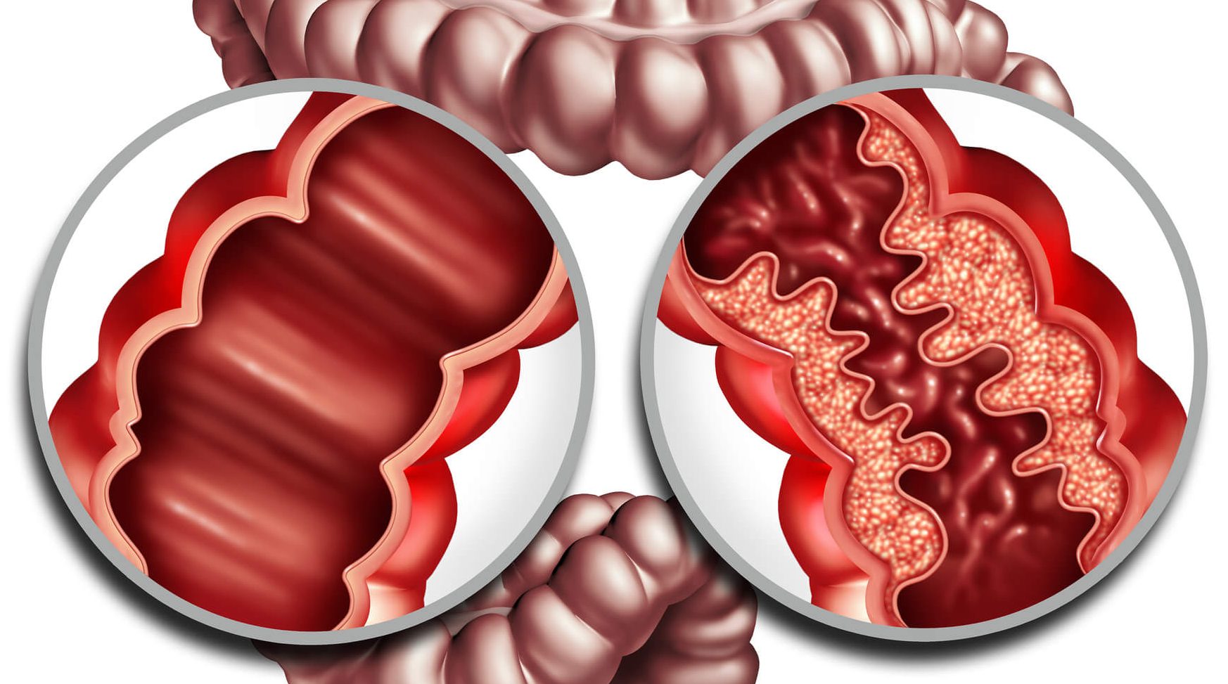 Crohn s Disease Causes Symptoms Diagnosis Treatment