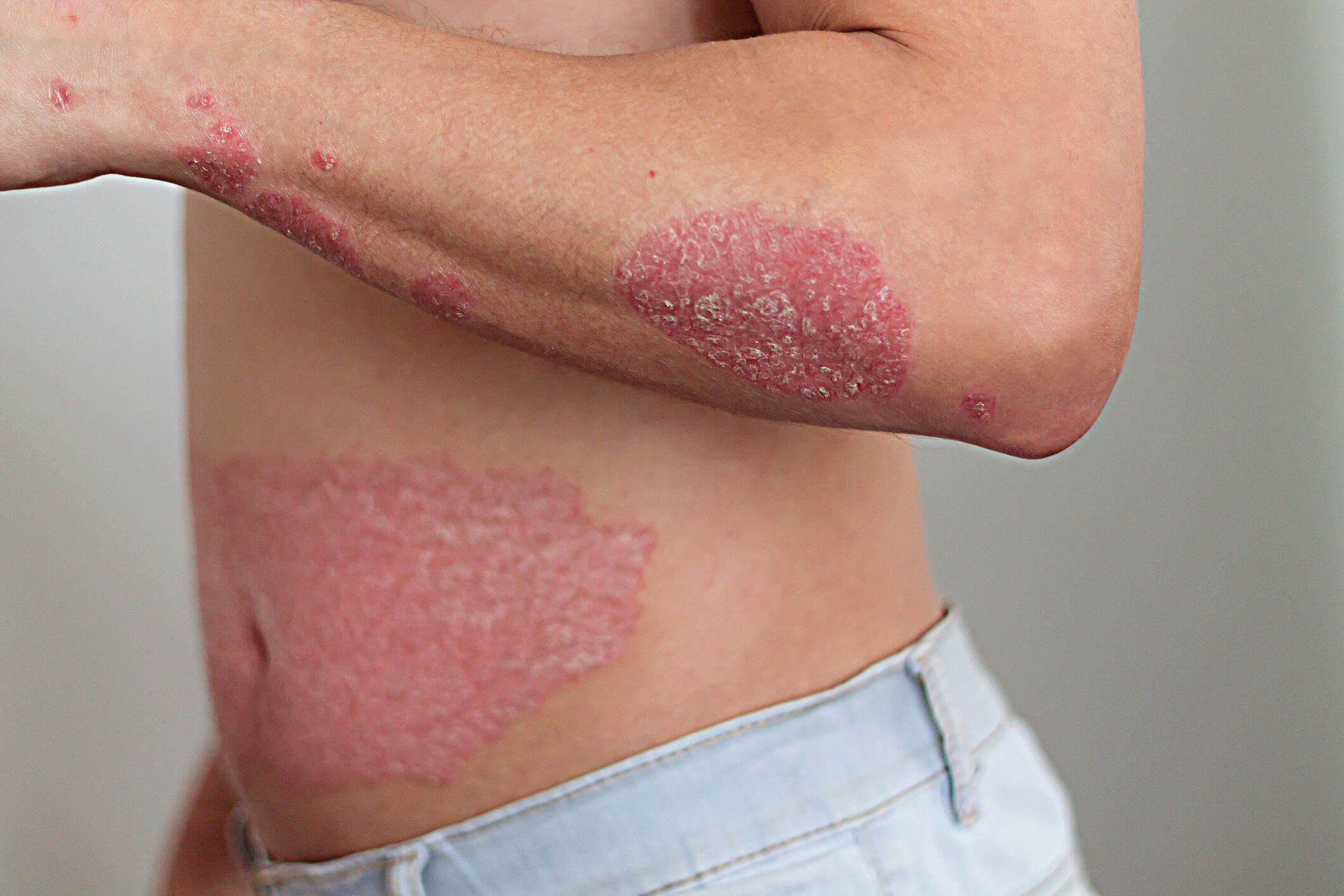 psoriasis skin disorder piros folt a nyakon viszket fénykép