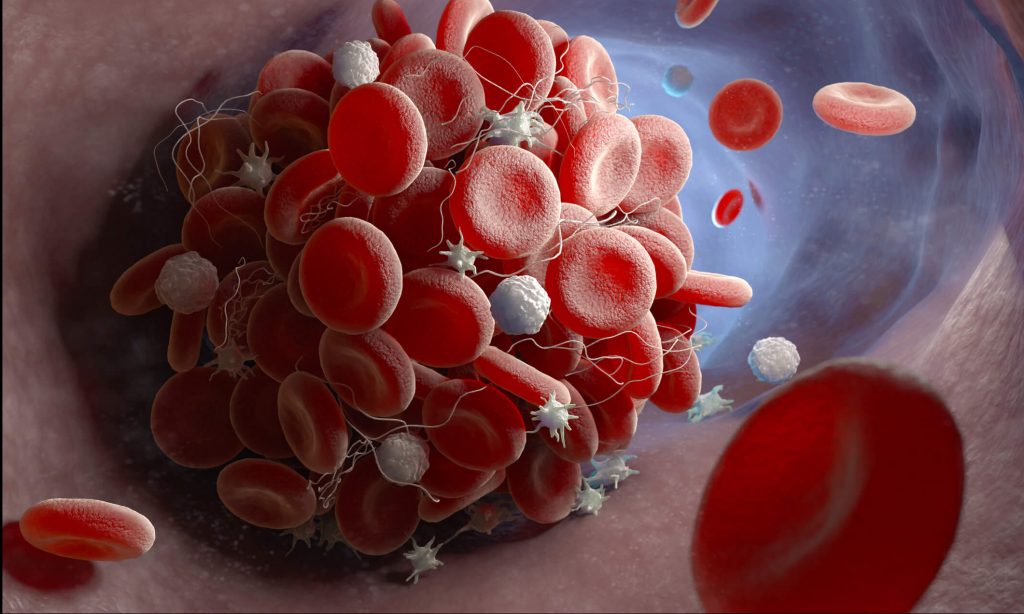 Deep Vein Thrombosis (DVT) Warnings Signs & Treatment