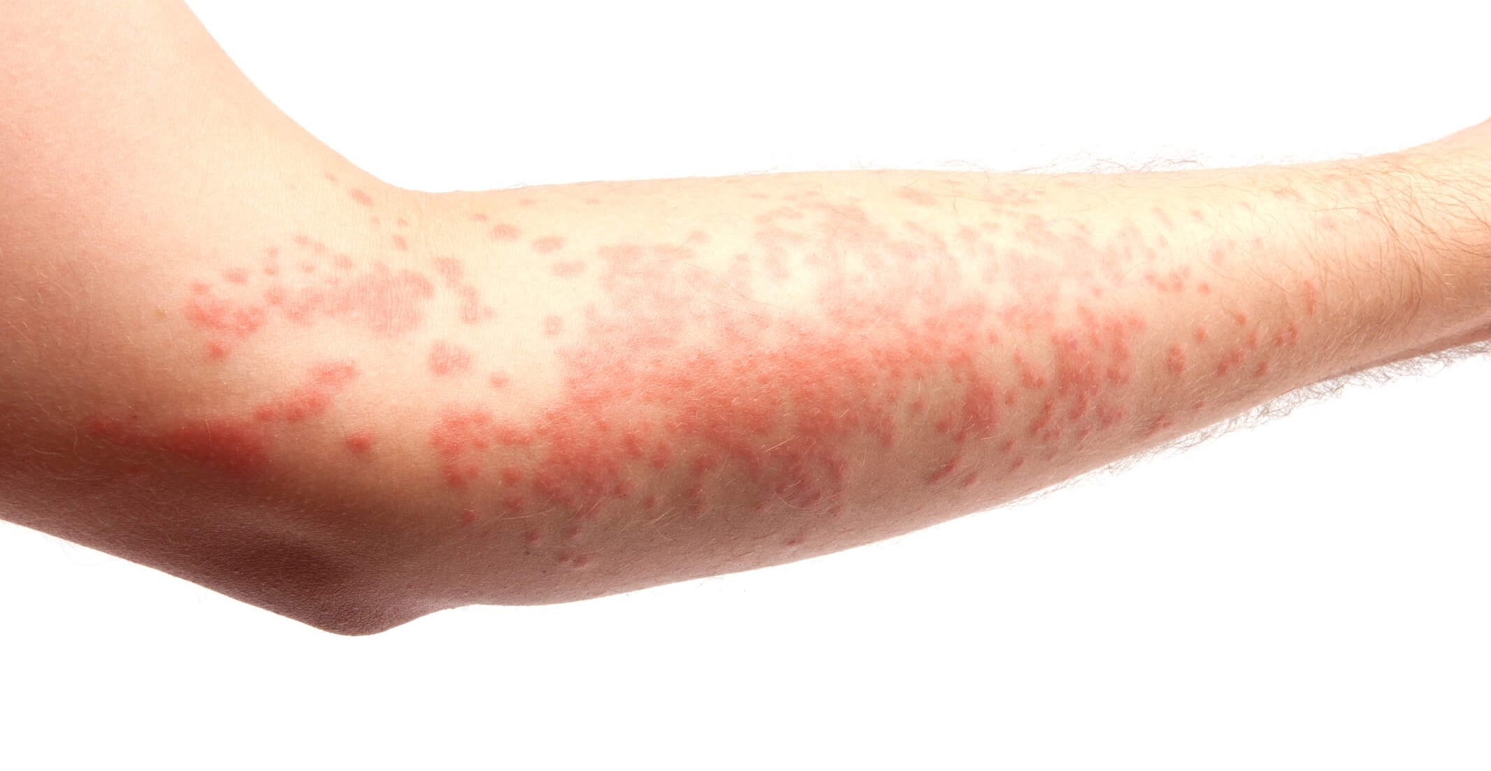 a) Day 1, patient presents with flat erythematous rash with scattered