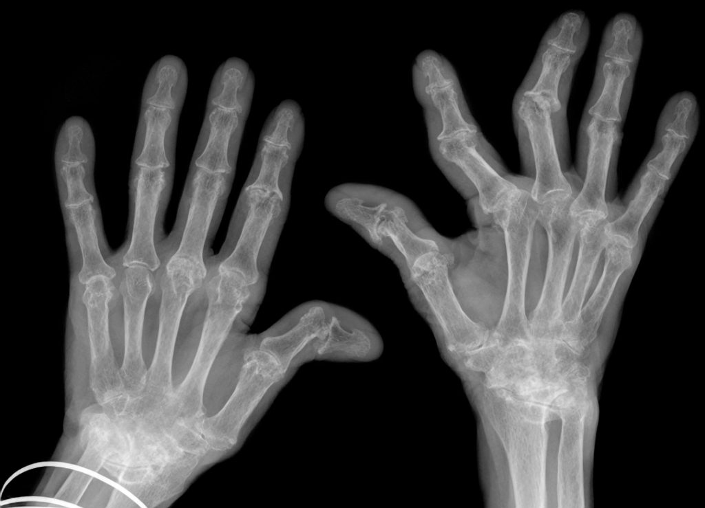 Rheumatoid Arthritis The 4 Stages of Rheumatoid Arthritis