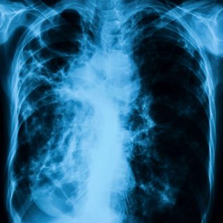 Chest x-ray image showing infection of lungs