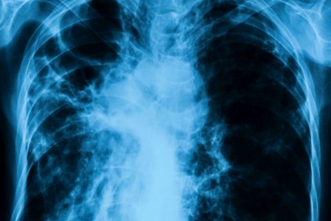 Chest x-ray image showing infection of lungs