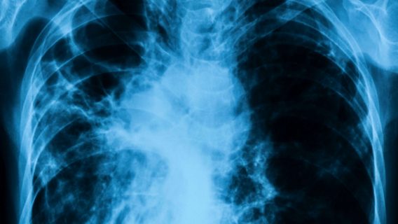 Chest x-ray image showing infection of lungs