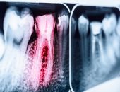 An dental X-ray of a decaying tooth, which could be the result of Suboxone use.