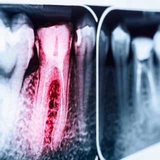 An dental X-ray of a decaying tooth, which could be the result of Suboxone use.