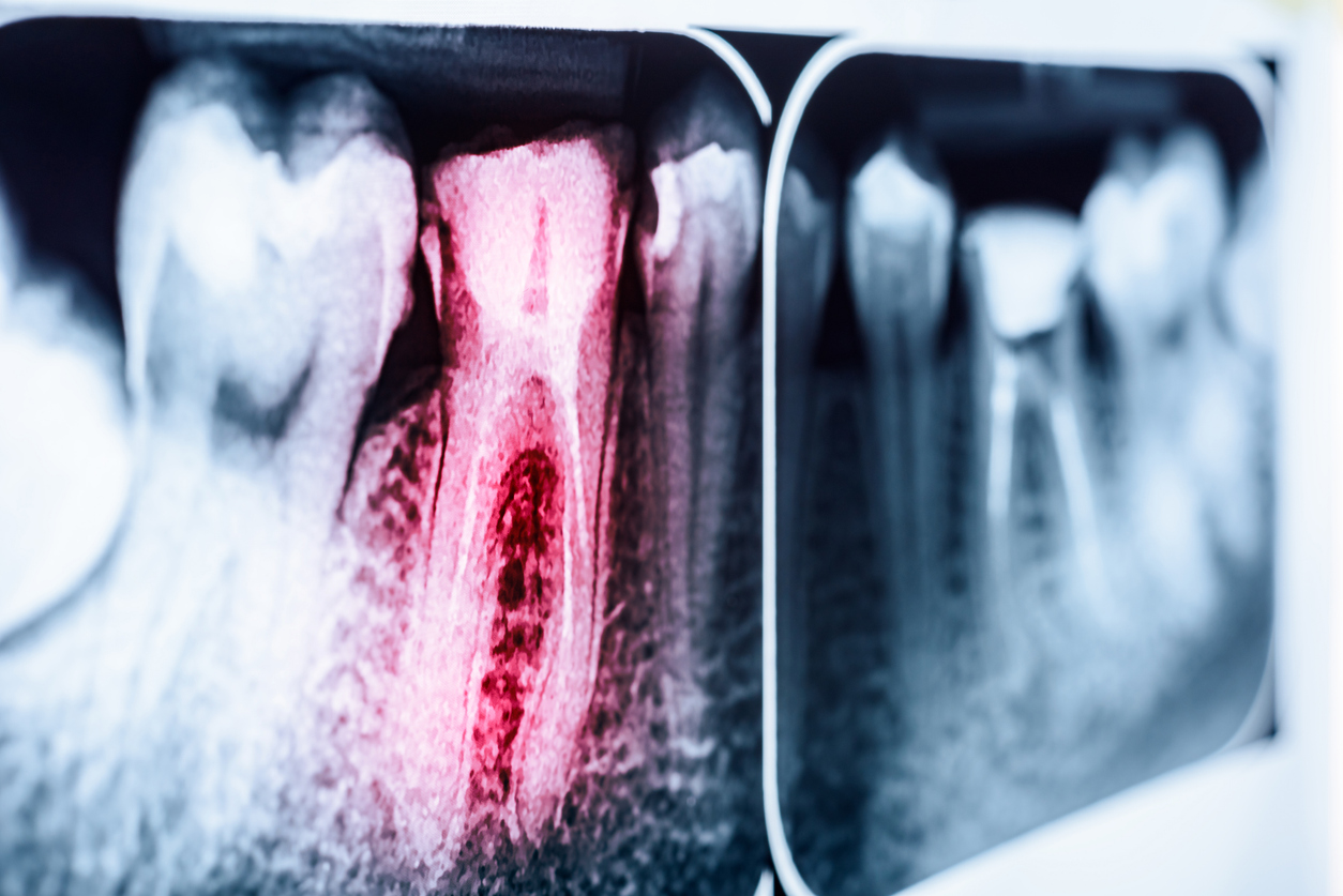 An dental X-ray of a decaying tooth, which could be the result of Suboxone use.