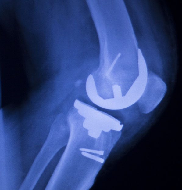 X-ray of Knee Replacement